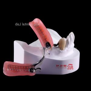 Lifelike Unilateral and Bilateral Lock Type Metal Precision Attachment with Free End Acrylic Dentures
