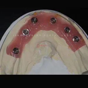 Implant-Supported Overdenture with Prefabricated Bar Attachment System