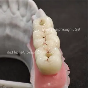 Replacing a Missing Tooth Free End 3 Unit Implant Products Dental Lab Custom Zirconia Crowns