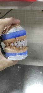 All Ceramic Porcelain Veneers with Natural Looking and High Aesthetic Dental Veneers