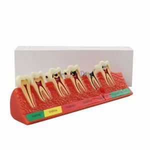 Dental Caries Illustration Model Resin Teeth Model Dental Teaching Dental Teeth