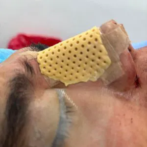 External Nasal Splint for Rhinoplasty Septoplasty Surgery Nose Fracture CE ISO13485