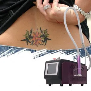 Q Switched ND YAG Laser Pigmentation Removal Machine for Beauty Salon