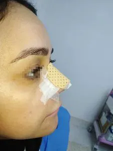 Thermoplastic Nasal Splint for Rhinoplasty Nose Plastic Surgery Fracture Recovery Immobilization