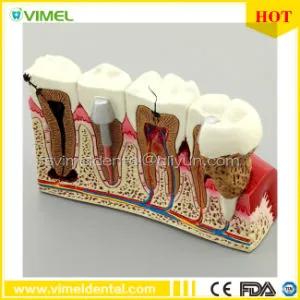Denture Study Teeth Model Common Pathologies Teaching Model Othodontic Products