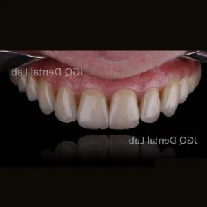 Customize Dentures Layered Zirconia Crown China Dental Lab Exocad