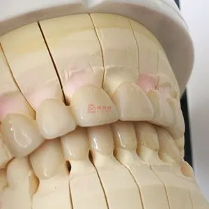 Dental Full Solid Zirconia Crowns and Bridges Fixed Dentures Restorations Privatation Customized China Dental Lab