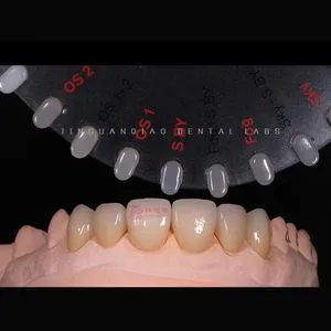 Best Zirconia Crowns and Bridges in Fixed Denture Restoration with High Aesthetic and Natural Looking