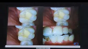 Dalaude Dental Medical HD Intra Oral Camera with 22inch Screen